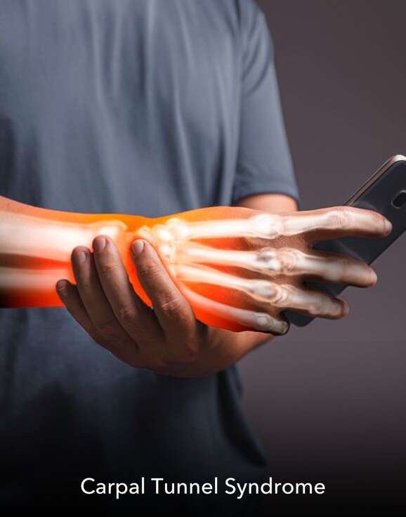 Carpal Tunnel Syndrome