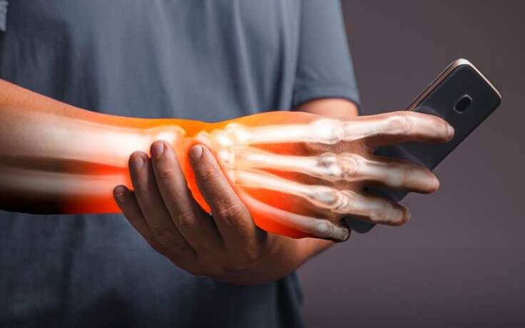 Carpal Tunnel Syndrome