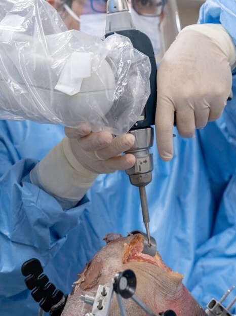 Robotic-Knee-Replacement-Surgery-in-Bangalore