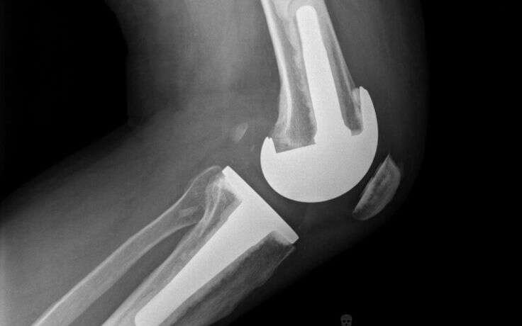Side view of a total knee revision_
