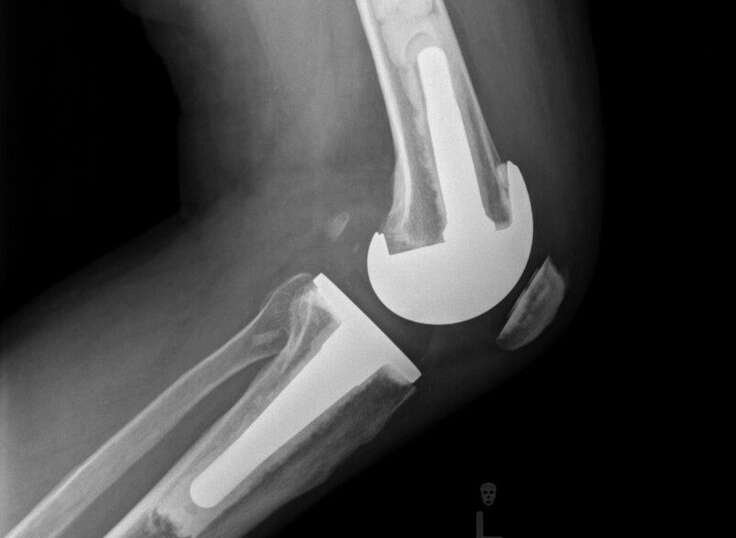 Side view of a total knee revision_