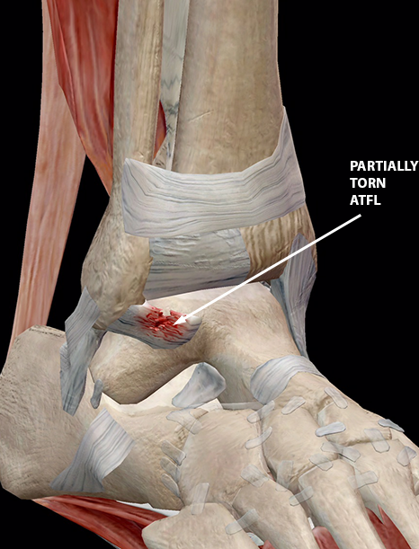 sports-injuries-grade-2-ankle-sprain-w3